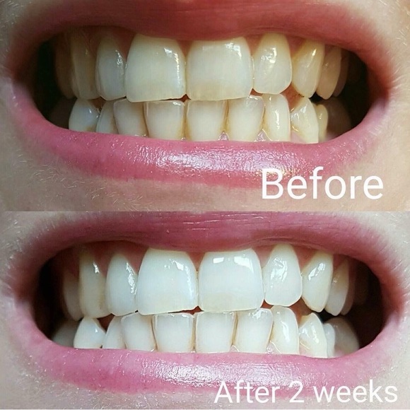 Whitening Toothpaste - Picture 12 of 16